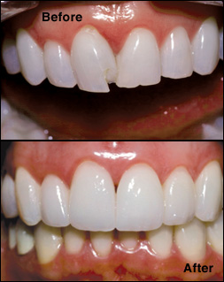 Composite bonding for chipped teeth